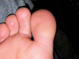 Podologist from Warsaw advises: How to remove a wart?